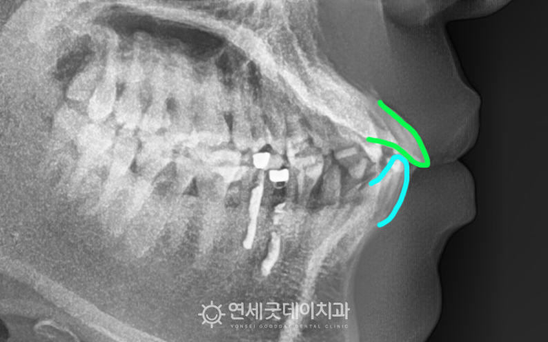 치아뻗침 및 앞니벌어짐교정을 위해 방문한 20대 남성 환자분
