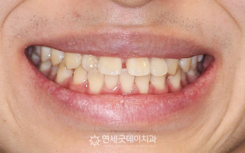 치아 사이가 벌어져 앞니벌어짐교정과 치아뻗침 개선을 위한 인비절라인 시행