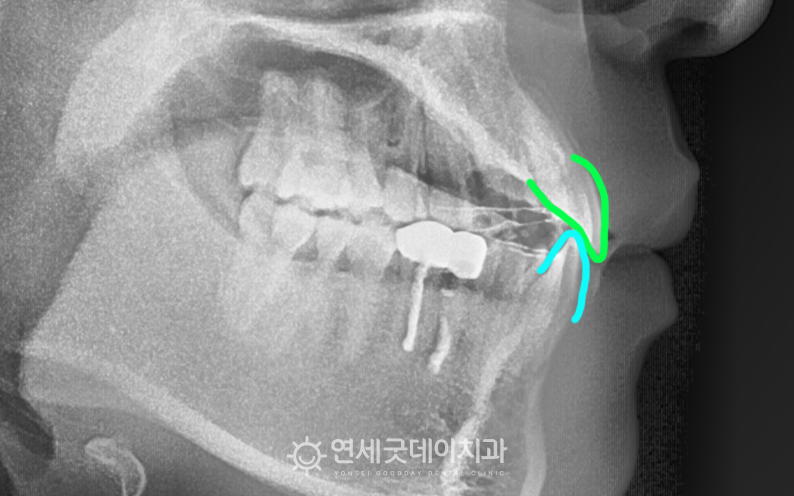 앞니벌어짐교정 완료 치아뻗침 개선 및 공간폐쇄 진행됨