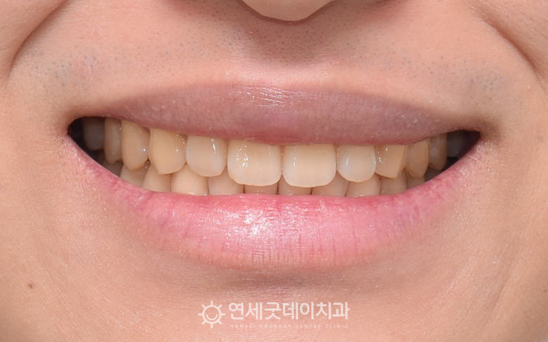 치아뻗침과 앞니벌어짐교정을 통해 안모가 정돈되었음