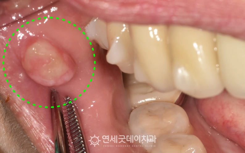 입안에물집처럼 구강 섬유종 발생