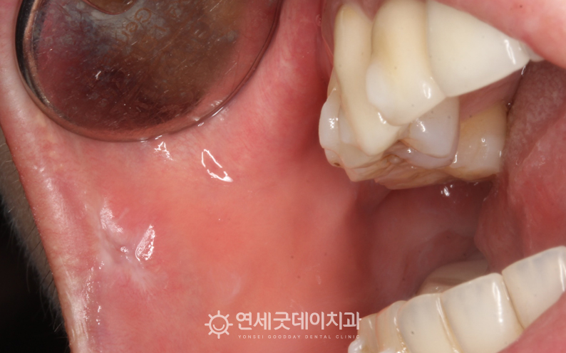 구강 섬유종 제거 후 입안에 물집처럼 보이던 부위가 말끔해짐