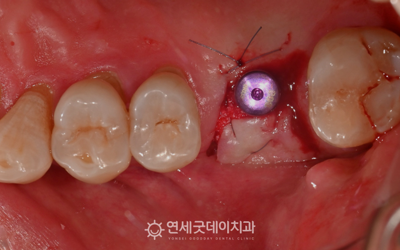 어금니 임플란트 진행 과정 - 취리히 술식을 이용한 당일 임플란트 진행