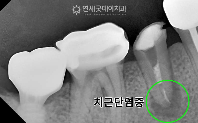 치근단염증으로 인한 재신경치료 전 모습