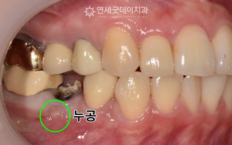 치근단염증으로 인해 누공이 발생하였으며 재신경치료 후 지르코니아 크라운 치료계획 수립