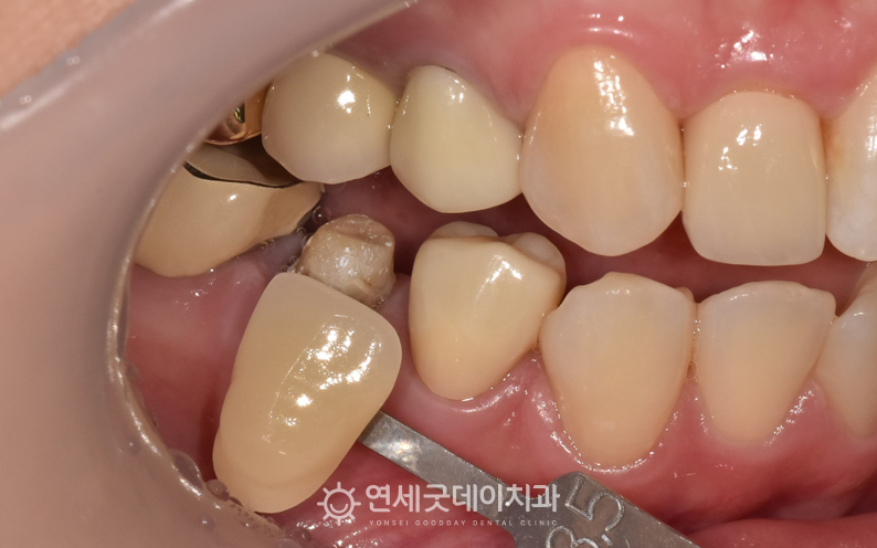 재신경치료 후 지르코니아 크라운 제작을 위해 쉐이드 대조