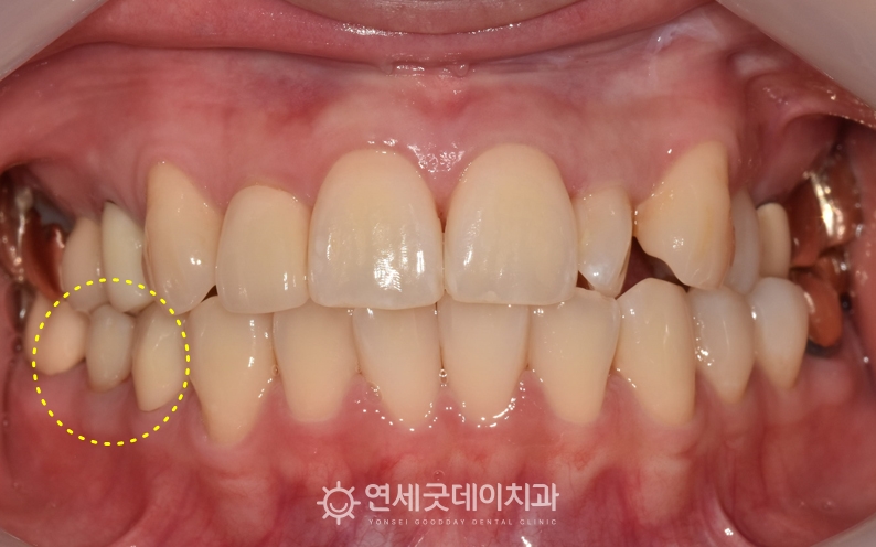 재신경치료 후 지르코니아 크라운 종결
