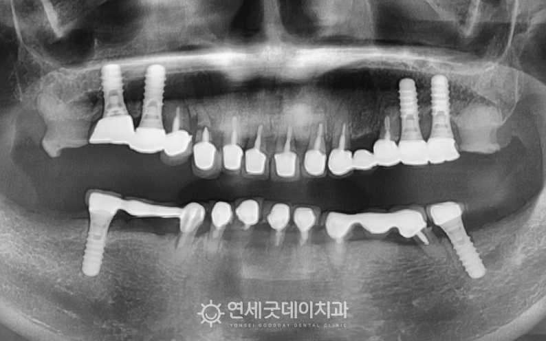 스트라우만 임플란트브릿지 치료 전 엑스레이