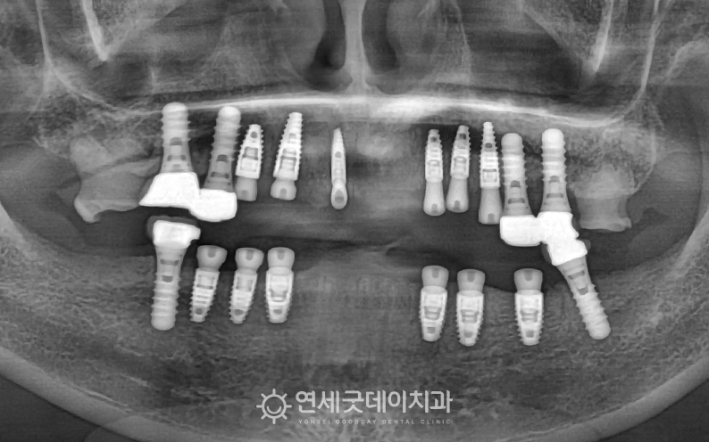 임플란트브릿지 치료 과정 - 스트라우만 임플란트 식립