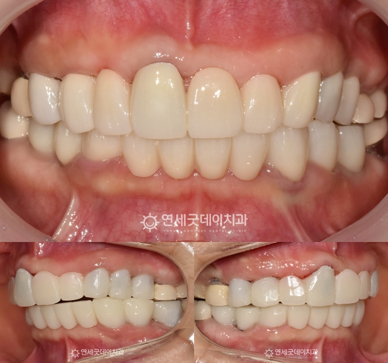 스트라우만을 이용한 임플란트브릿지 치료 완료