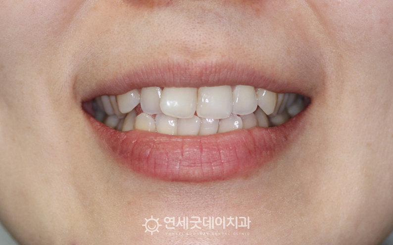 인비절라인 덧니교정 전 안모 모습