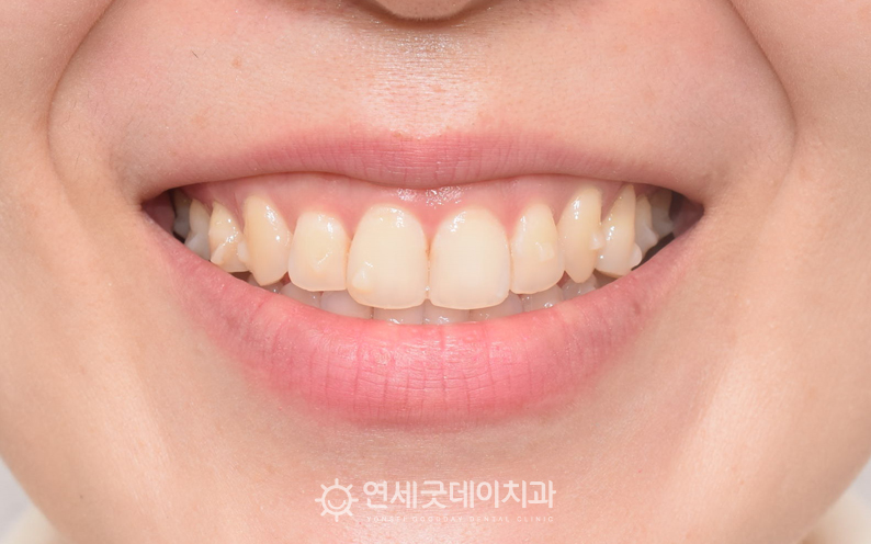 덧니교정 진행 과정이며 비발치교정만으로도 치아 배열의 균형을 이룸