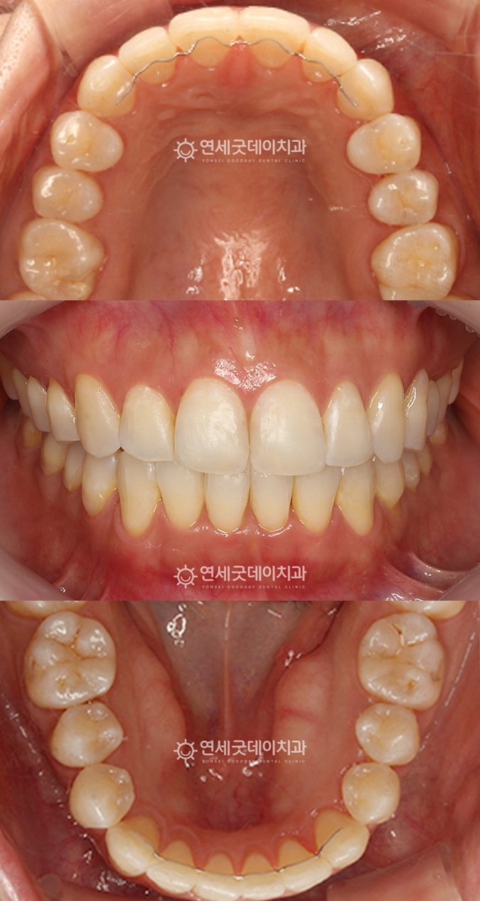 인비절라인을 이용한 덧니교정 종결, 비발치교정