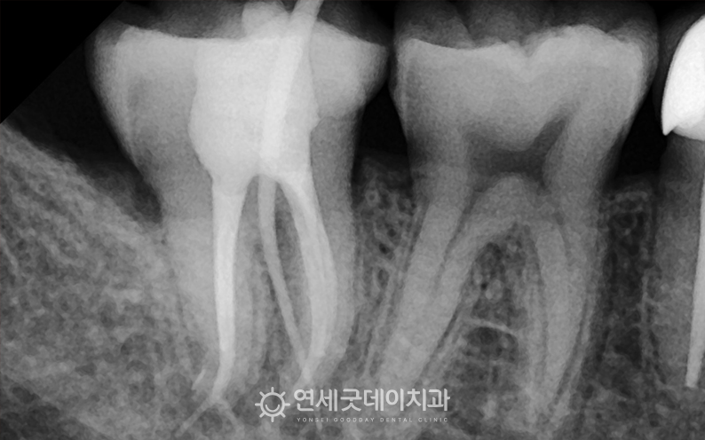 치아재식술 전 엑스레이 촬영본이며, 치근단 염증이 재발함