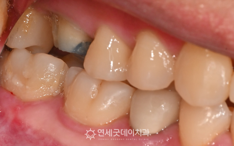 타원에서 진행한 보철물 제거한 모습이며 지르코니아 크라운으로 교체 진행 계획 수립함