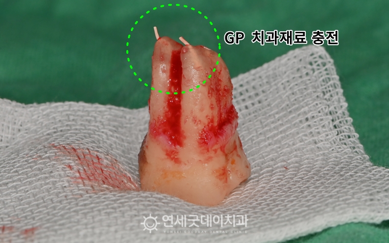 치아재식술을 통해 발치한 후 치과재료로 신경관을 충전한 모습