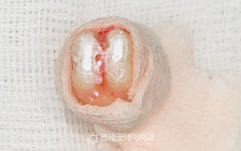 치아재식술 마무리 과정이며 빈 신경관을 재료로 채운 모습이다.