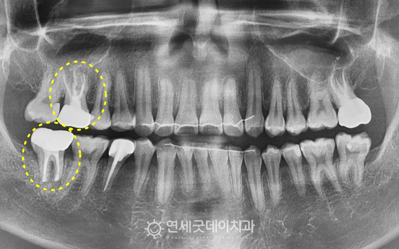 치아재식술 및 타원 크라운 교체 완료 후 엑스레이 촬영
