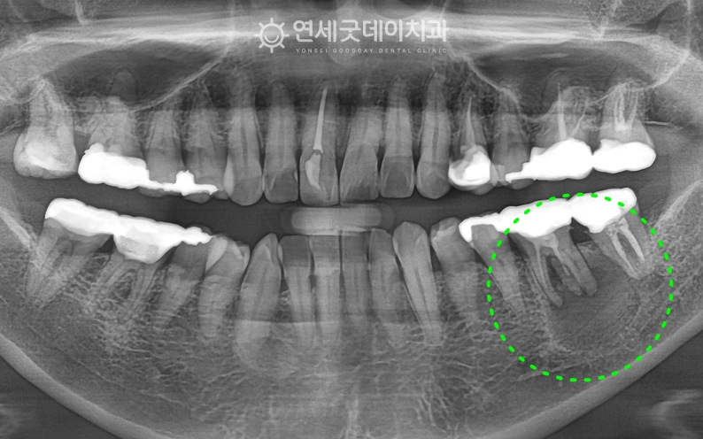 하치조신경이 있는 위치에 치성낭종이 발생함