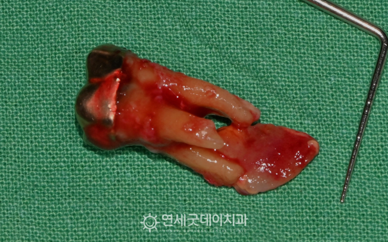 문제 부위 발치 및 치성낭종 제거