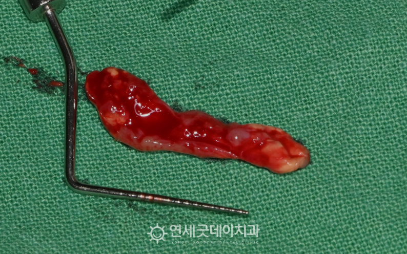 치성낭종 제거 모습이며 상당한 크기의 염증이 관찰됨