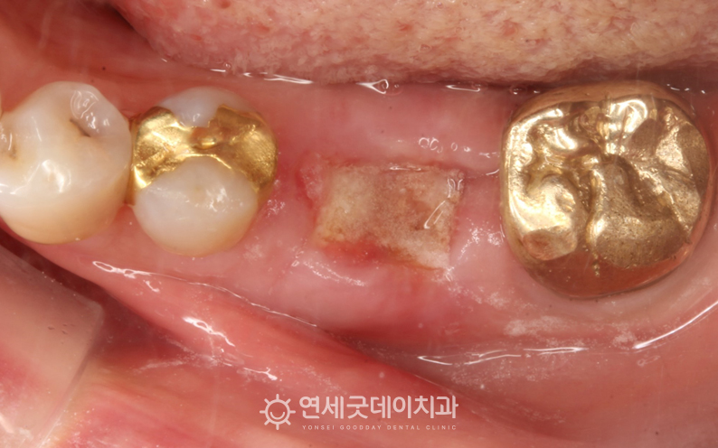 치성낭종 제거 부위에 급속골이식 후 건강한 뼈가 차오른 모습