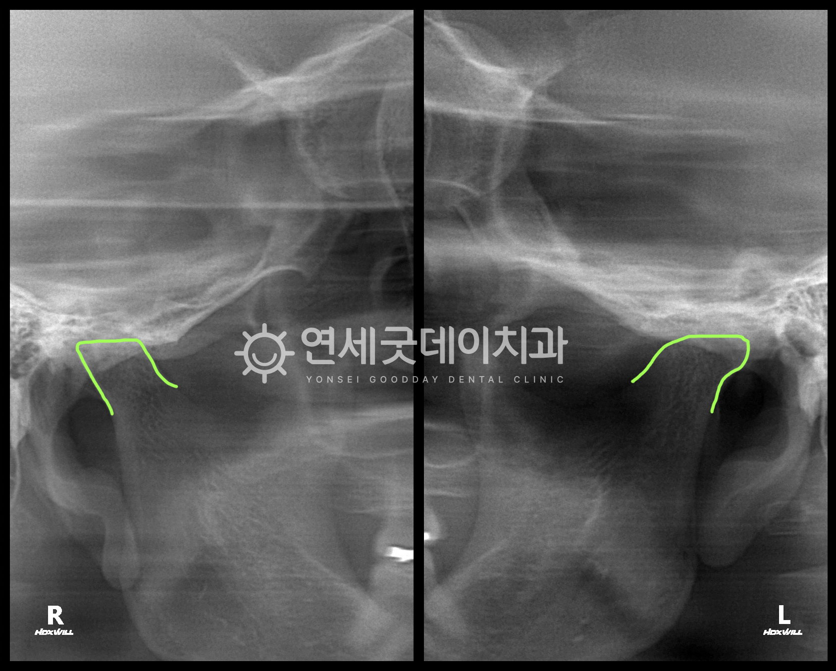 턱관절의 퇴행성관절염으로 인해 뼈가 녹은 모습