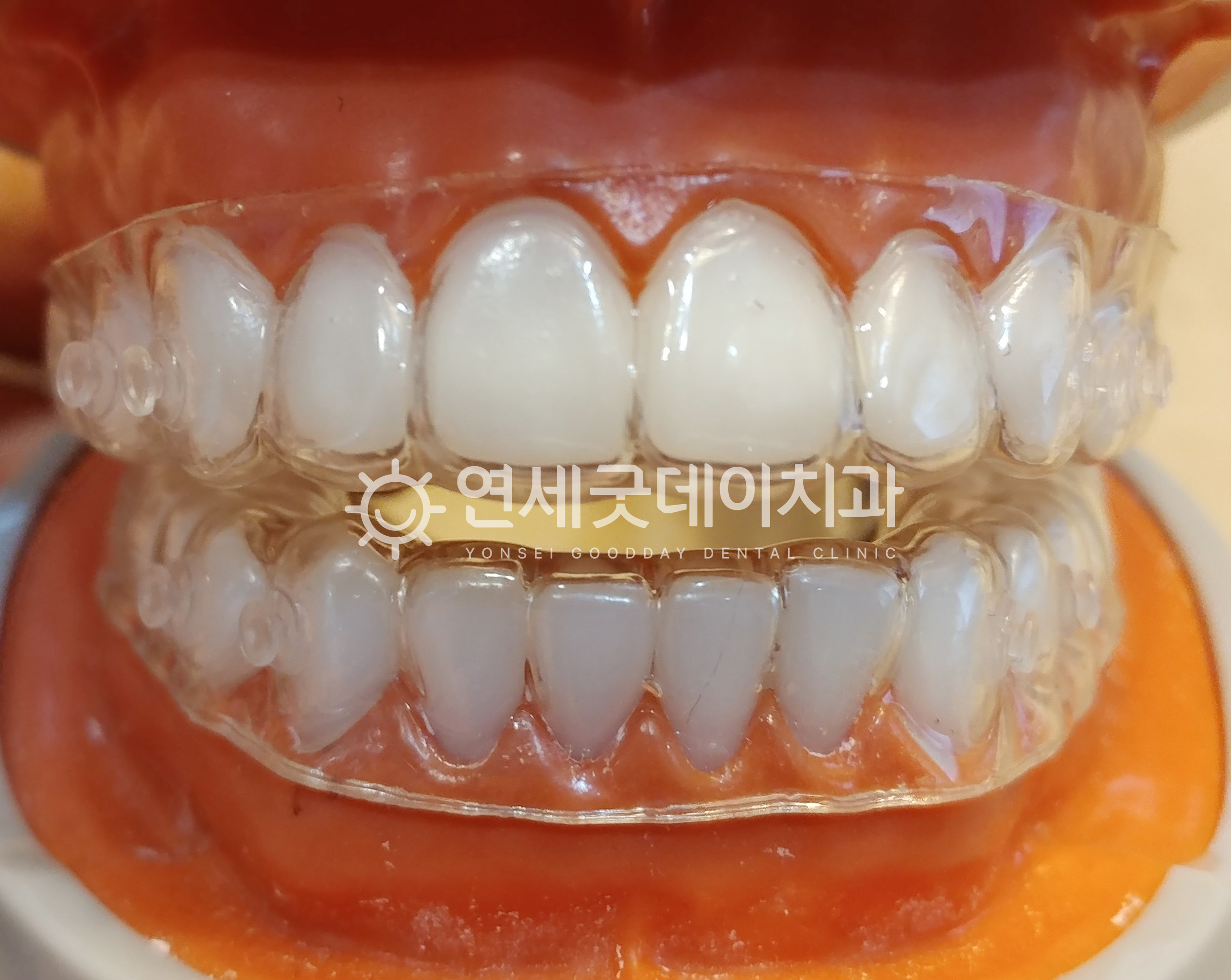 개방교합과 턱관절교정에 쓰이는 트랙션