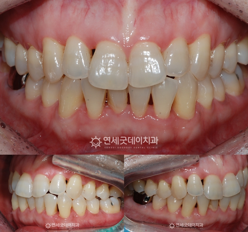 트랙션을 이용한 턱관절교정 1년 후 구내모습
