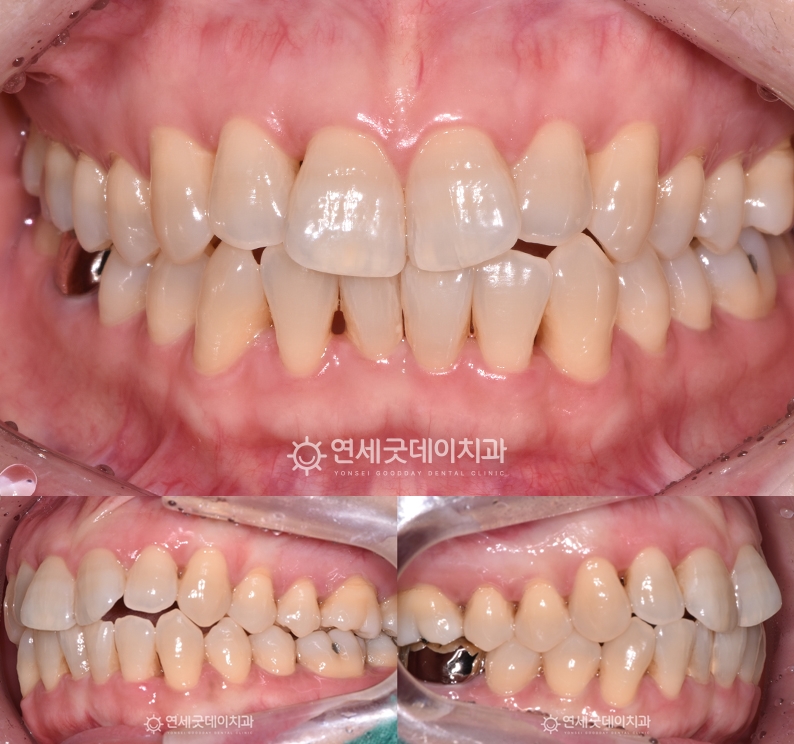 트랙션을 이용한 턱관절교정 후 2년 경과
