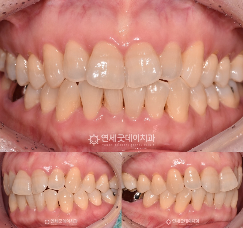 트랙션을 이용한 턱관절교정 종결, 개방교합이 개선된 구내모습