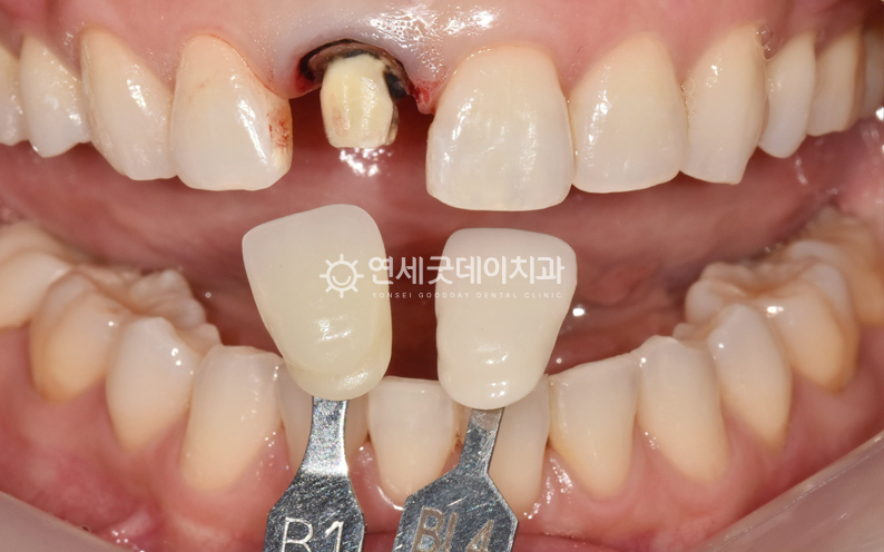앞니 크라운 교체 전 지르코니아 크라운 쉐이드 대조 모습