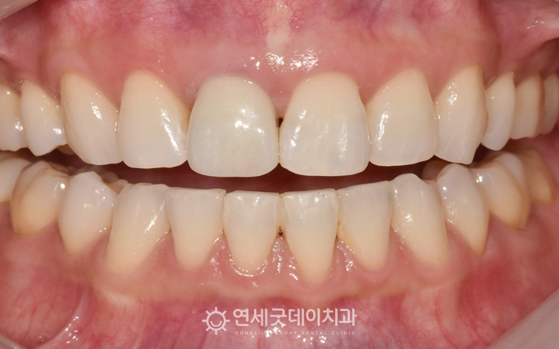 PFM 크라운에서 지르코니아 크라운으로 앞니 크라운 교체 진행