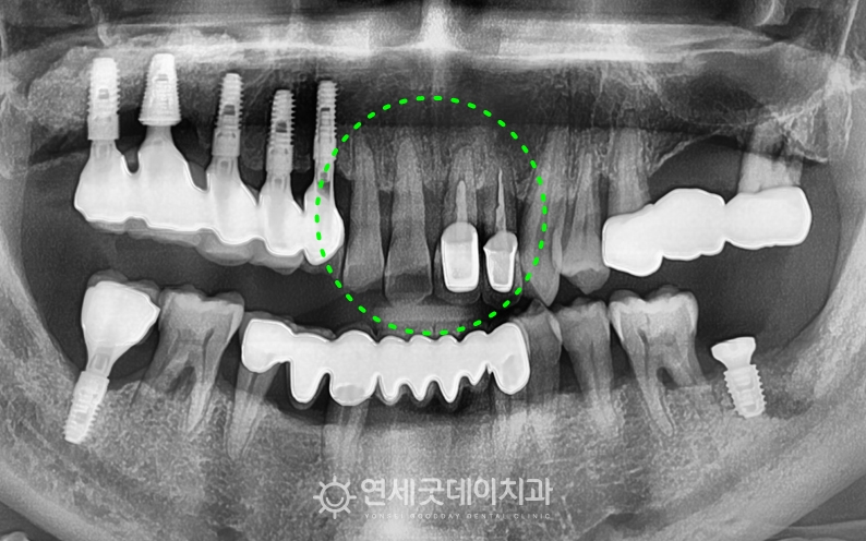 앞니크라운 빠짐으로 앞니 임플란트 브릿지 희망하심. 치료전 엑스레이 촬영.
