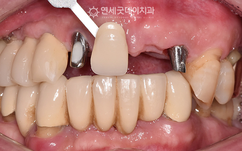 앞니 임플란트 브릿지 제작을 위한 쉐이드 대조 진행 모습