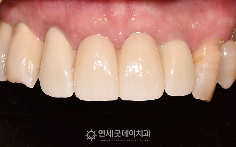 앞니 임플란트 브릿지 치료 후 구내모습