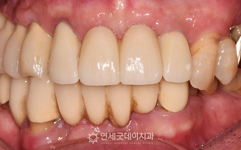 두툼한 잇몸뼈 위로 앞니 임플란트 브릿지가 잘 심어진 결과