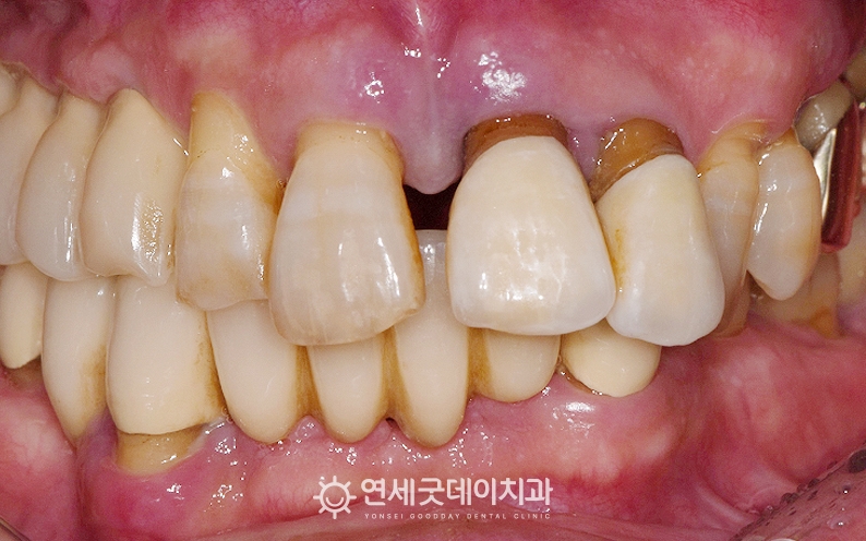 타원에서 진행한 앞니크라운을 제거 및 발치한 후 앞니 임플란트 브릿지 진행 예정