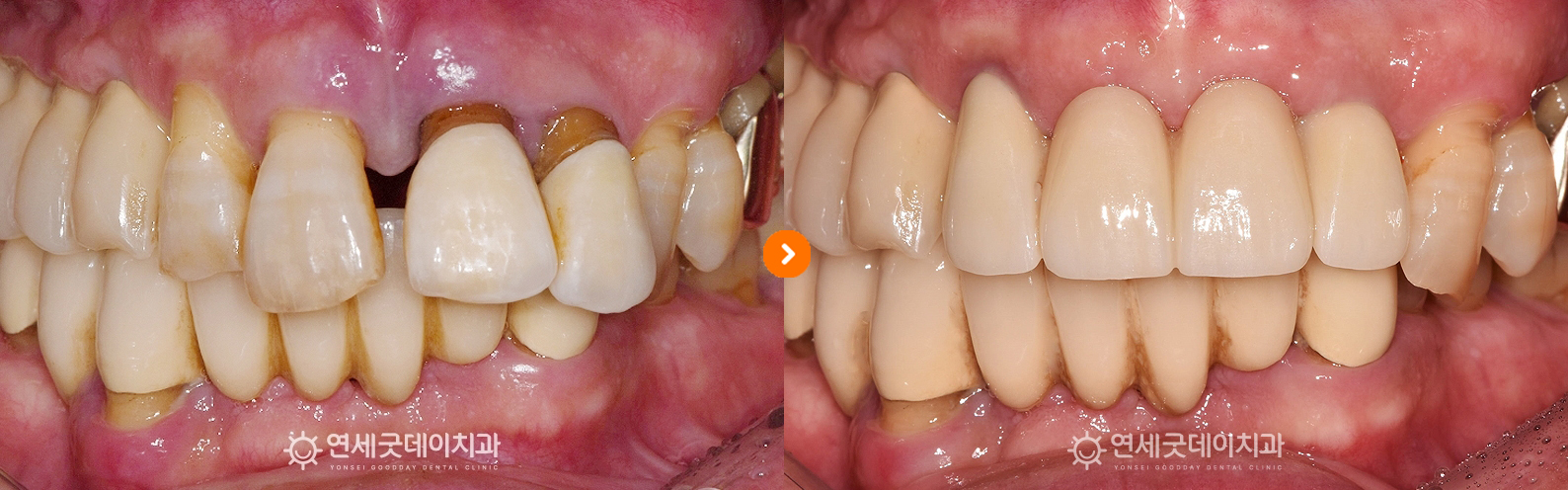 앞니 임플란트 브릿지 치료전후 비교 (구내모습)