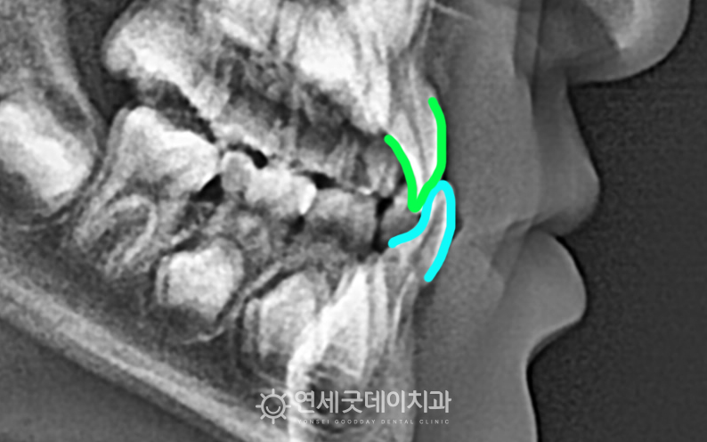 어린이반대교합으로 성장기치아교정 희망 x-ray 모습