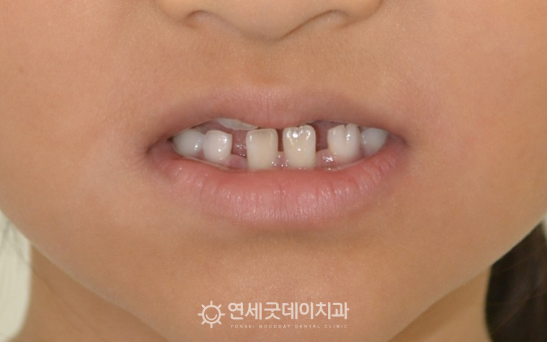 어린이반대교합 개선을 위해 프리올소를 이용한 성장기치아교정 진행