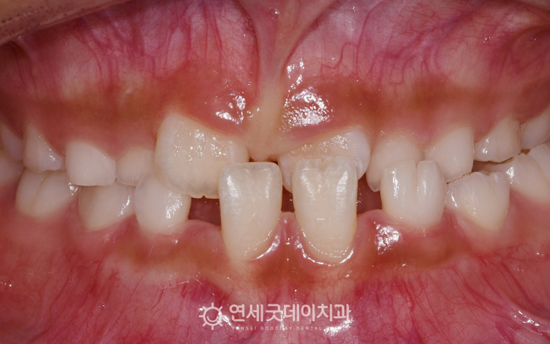 성장기치아교정이 필요한 어린이반대교합 - 프리올소 치료 전