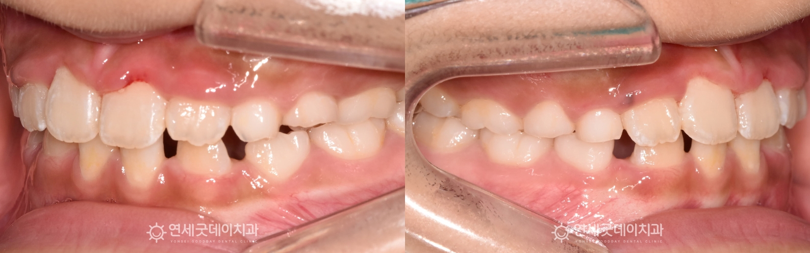 성장기치아교정을 통해 어린이반대교합이 개선됨 - 프리올소 적용