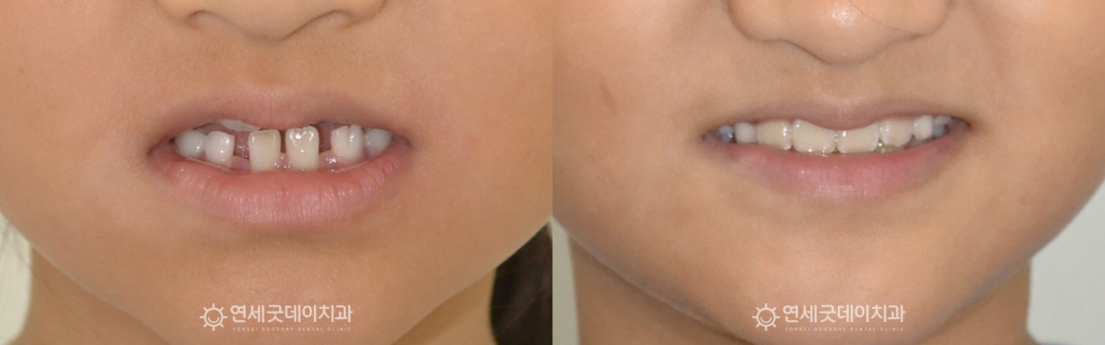 어린이반대교합 프리올소 성장기치아교정 치료전후 (안모)