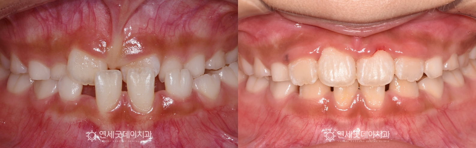 어린이반대교합 프리올소 성장기치아교정 치료전후 (구내)