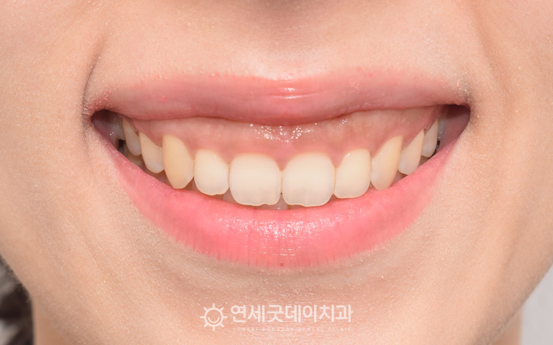 잇몸돌출로 인한 거미스마일 교정 희망, 구강전정술 치료전 모습