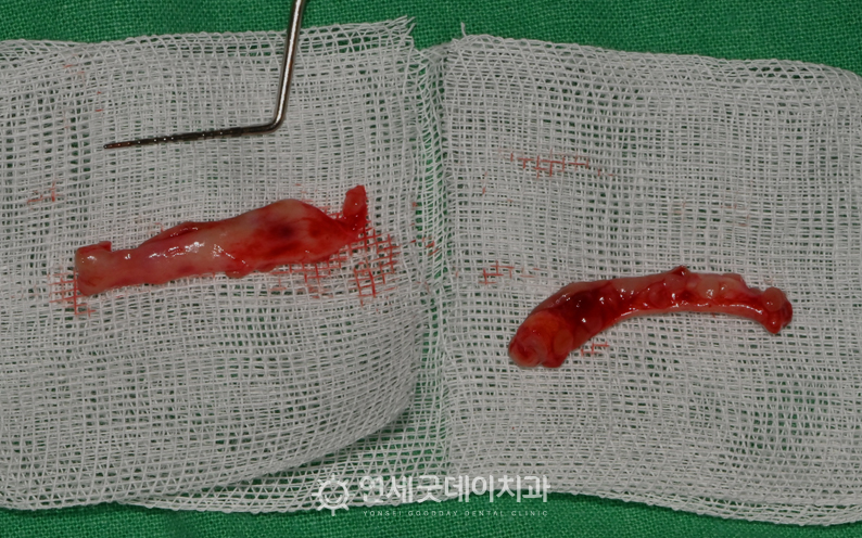 구강전정술 과정 중 잇몸표층을 제거함