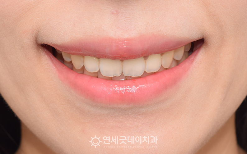 구강전정술을 통한 거미스마일 교정 후 안모모습