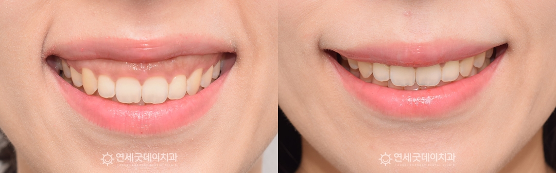 잇몸돌출로 인한 구강전정술 치료 시행 - 거미스마일 교정전후