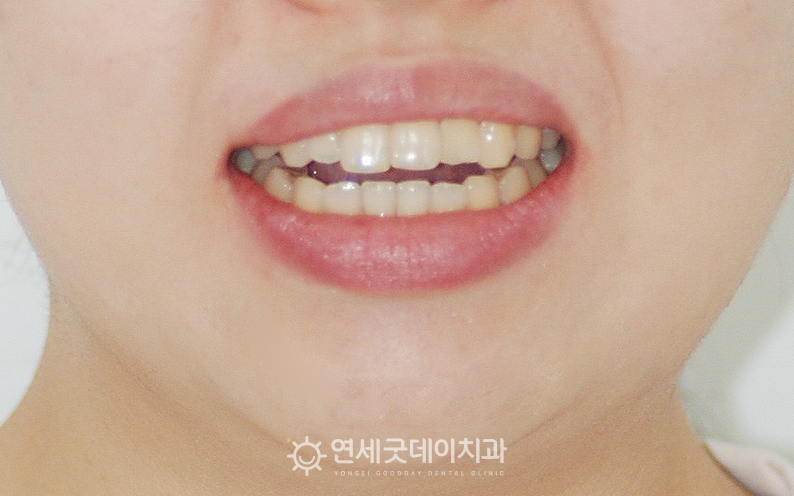 턱관절교정 전 개방교합으로 인해 앞니가 뜨는 모습